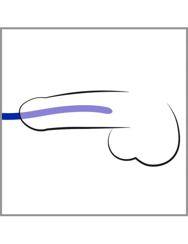 Silikone Dilator Sæt - 3 Pak - Blå