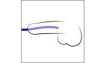 Silikone Dilator Sæt - 3 Pak - Blå